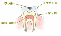 C1　エナメル質の虫歯