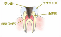 C3　神経まで達した虫歯