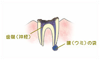 C4　歯根まで達した虫歯