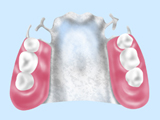 チタン床義歯