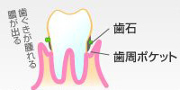 第2段階（軽度歯周炎）